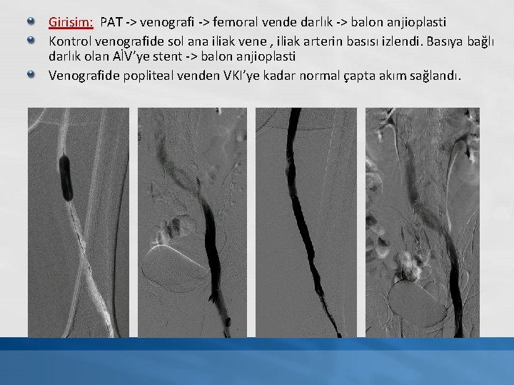 Girişim: PAT -> venografi -> femoral vende darlık -> balon anjioplasti Kontrol venografide sol