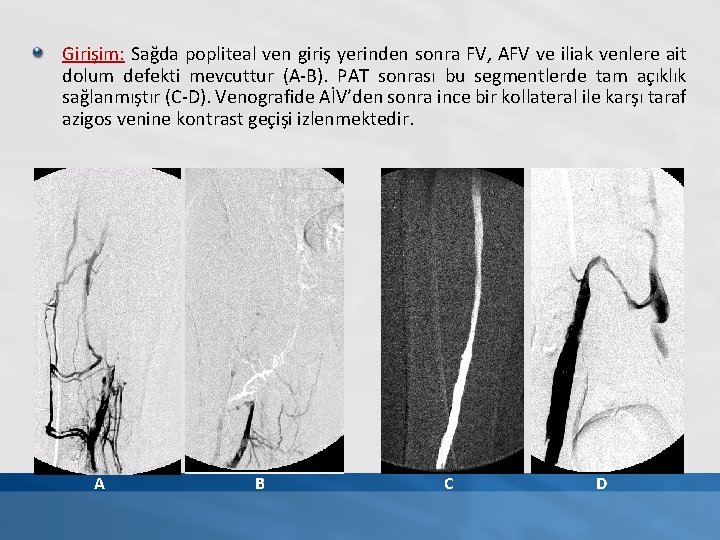 Girişim: Sağda popliteal ven giriş yerinden sonra FV, AFV ve iliak venlere ait dolum