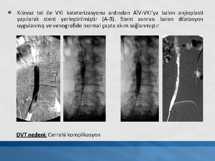 Kılavuz tel ile VKI kateterizasyonu ardından AİV-VKI’ya balon anjioplasti yapılarak stent yerleştirilmiştir (A-B). Stent