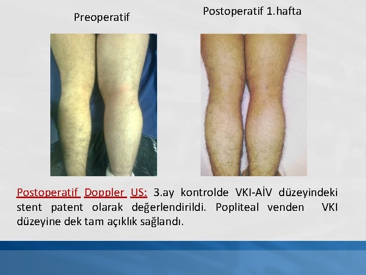 Preoperatif Postoperatif 1. hafta Postoperatif Doppler US: 3. ay kontrolde VKI-AİV düzeyindeki stent patent