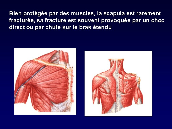 Bien protégée par des muscles, la scapula est rarement fracturée, sa fracture est souvent