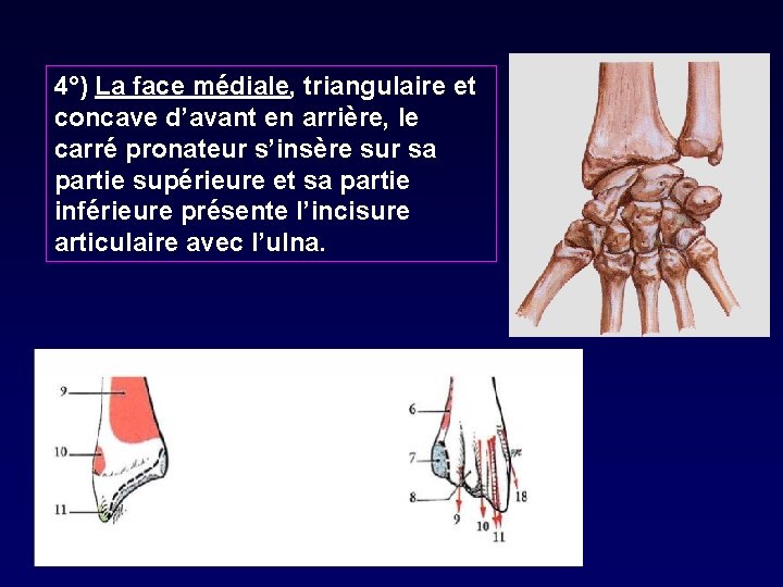 4°) La face médiale, triangulaire et concave d’avant en arrière, le carré pronateur s’insère