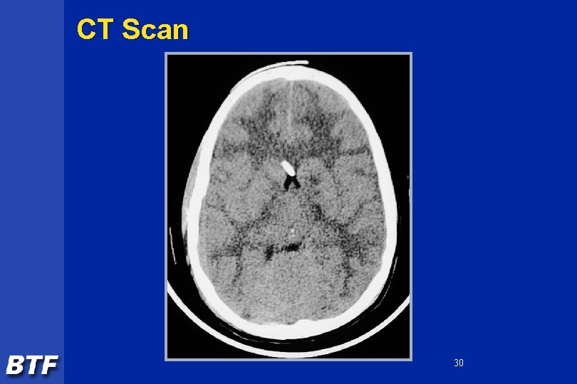 CT Scan 30 