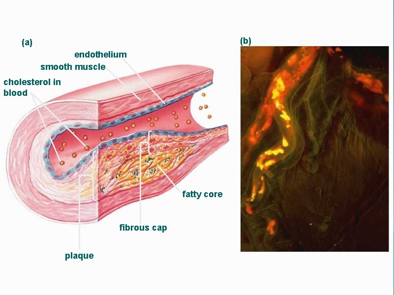 (b) (a) endothelium smooth muscle cholesterol in blood fatty core fibrous cap plaque 