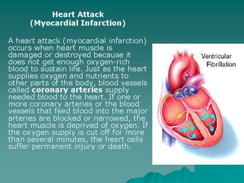 Heart Attack (Myocardial Infarction) A heart attack (myocardial infarction) occurs when heart muscle is