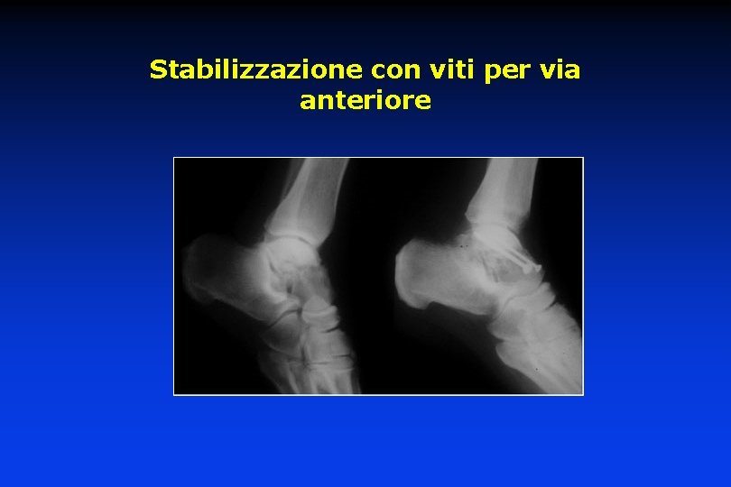 Stabilizzazione con viti per via anteriore 