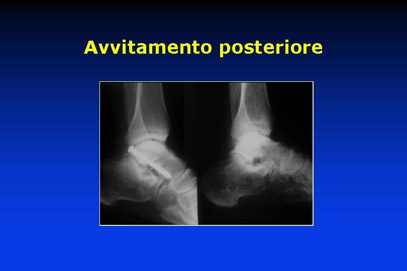 Avvitamento posteriore 