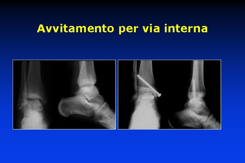 Avvitamento per via interna 