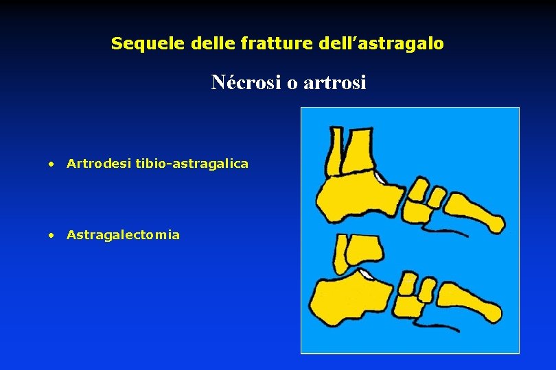 Sequele delle fratture dell’astragalo Nécrosi o artrosi • Artrodesi tibio-astragalica • Astragalectomia 