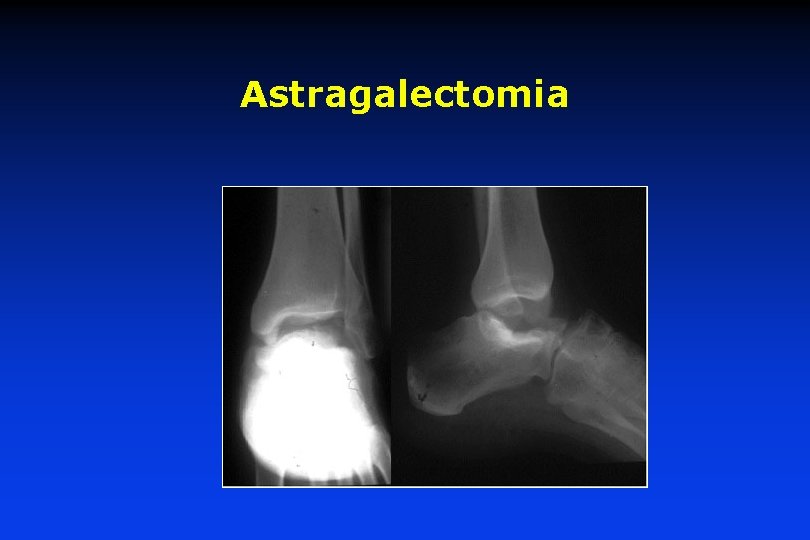 Astragalectomia 