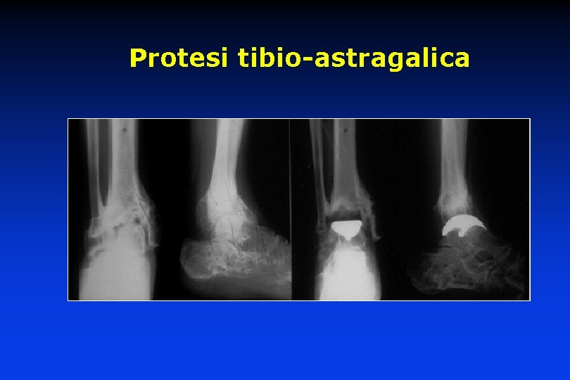 Protesi tibio-astragalica 