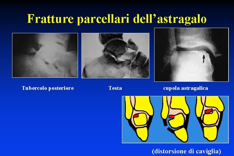 Fratture parcellari dell’astragalo Tubercolo posteriore Testa cupola astragalica (distorsione di caviglia) 