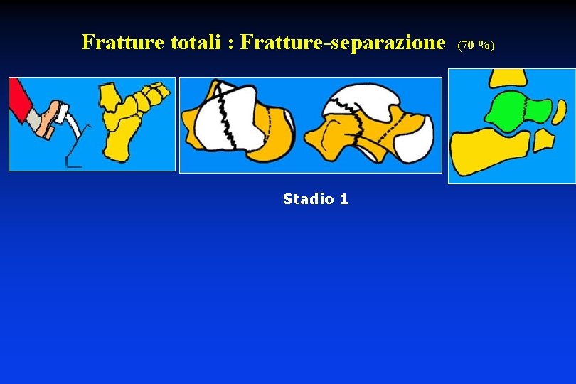 Fratture totali : Fratture-separazione Stadio 1 (70 %) 