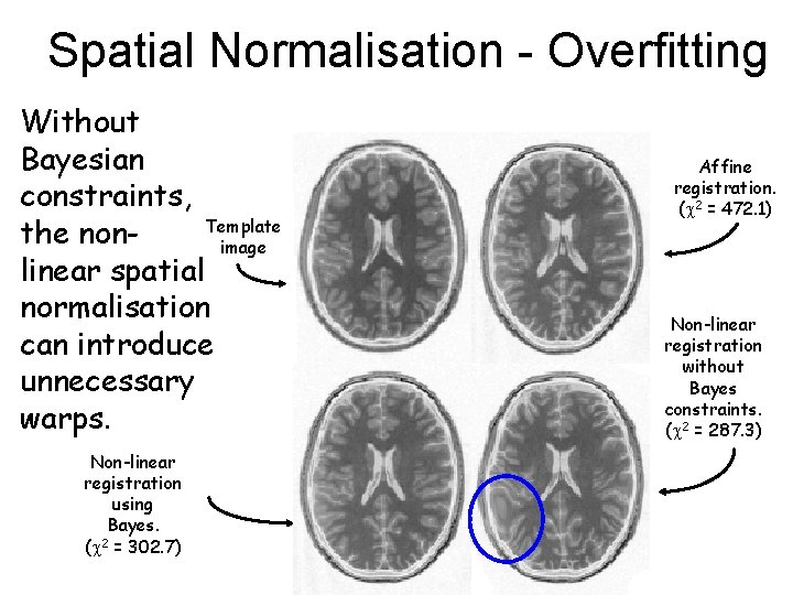 Spatial Normalisation - Overfitting Without Bayesian constraints, Template the nonimage linear spatial normalisation can
