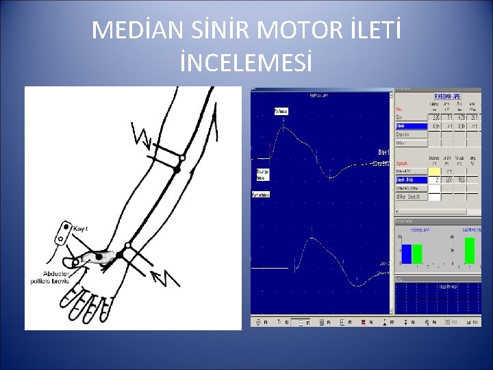 MEDİAN SİNİR MOTOR İLETİ İNCELEMESİ 