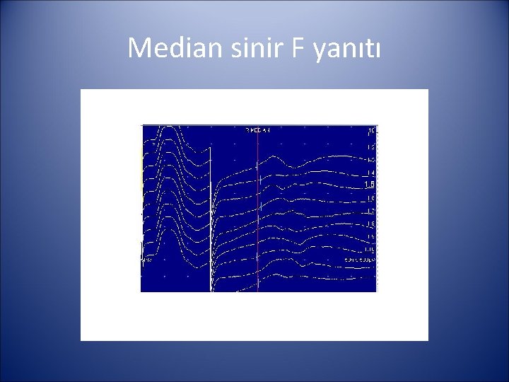 Median sinir F yanıtı 
