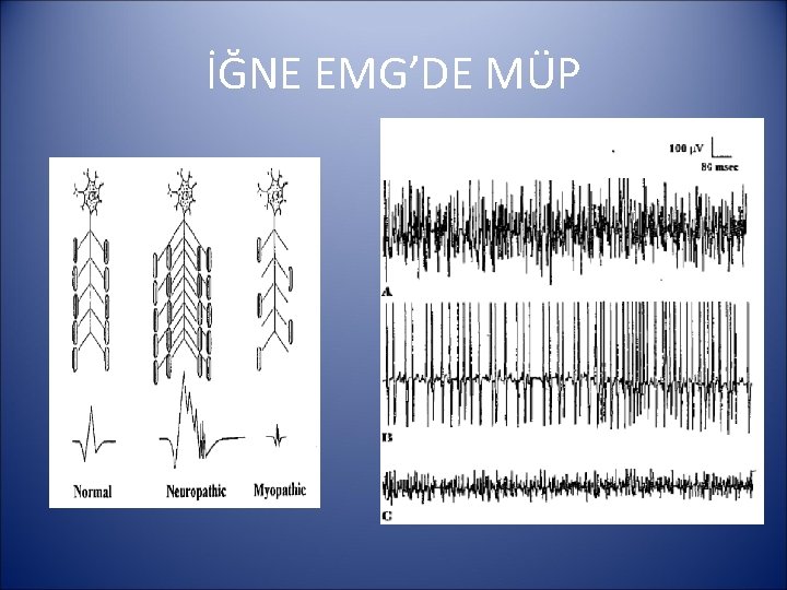 İĞNE EMG’DE MÜP 