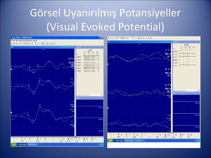 Görsel Uyanırılmış Potansiyeller (Visual Evoked Potential) 