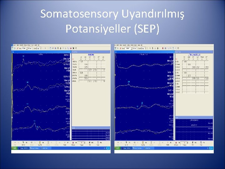 Somatosensory Uyandırılmış Potansiyeller (SEP) 