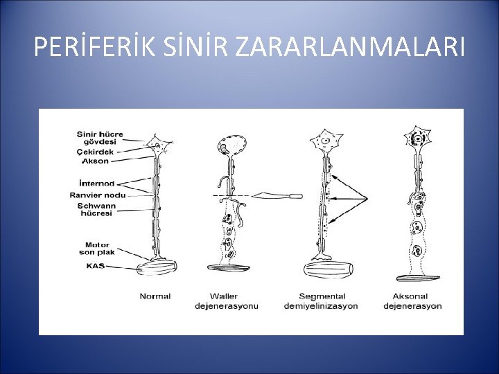 PERİFERİK SİNİR ZARARLANMALARI 