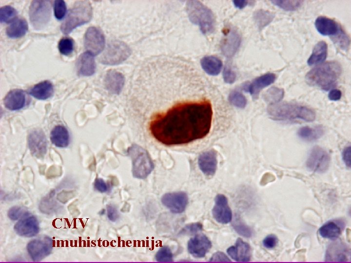 CMV imuhistochemija 