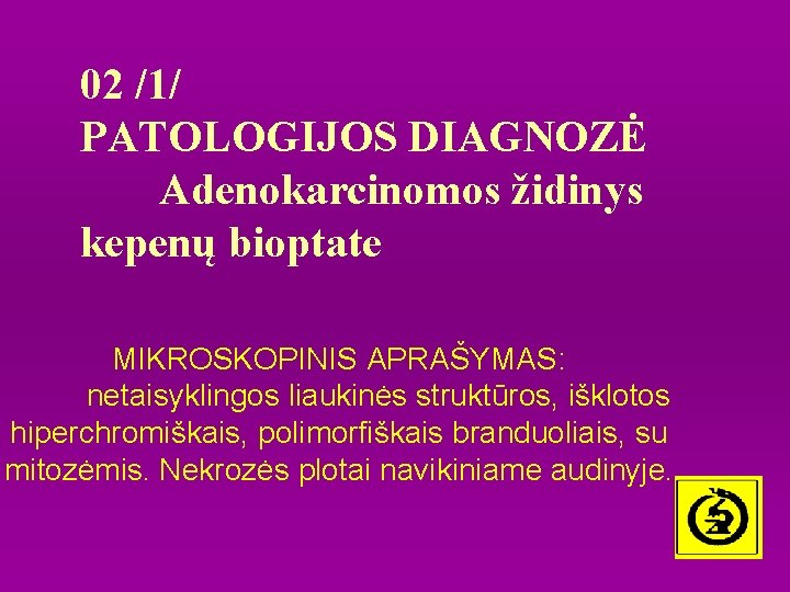 02 /1/ PATOLOGIJOS DIAGNOZĖ Adenokarcinomos židinys kepenų bioptate MIKROSKOPINIS APRAŠYMAS: netaisyklingos liaukinės struktūros, išklotos