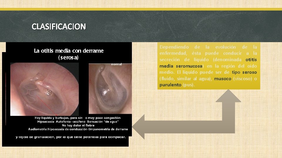 CLASIFICACION Dependiendo de la evolución de la enfermedad, ésta puede conducir a la secreción