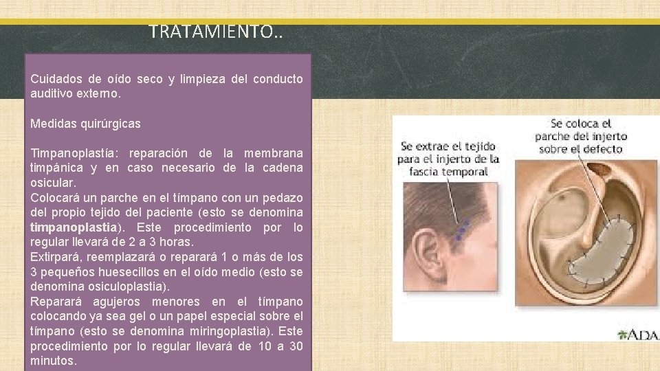 TRATAMIENTO. . Cuidados de oído seco y limpieza del conducto auditivo externo. Medidas quirúrgicas