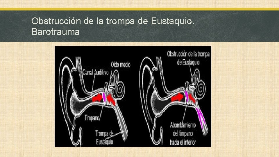 Obstrucción de la trompa de Eustaquio. Barotrauma 
