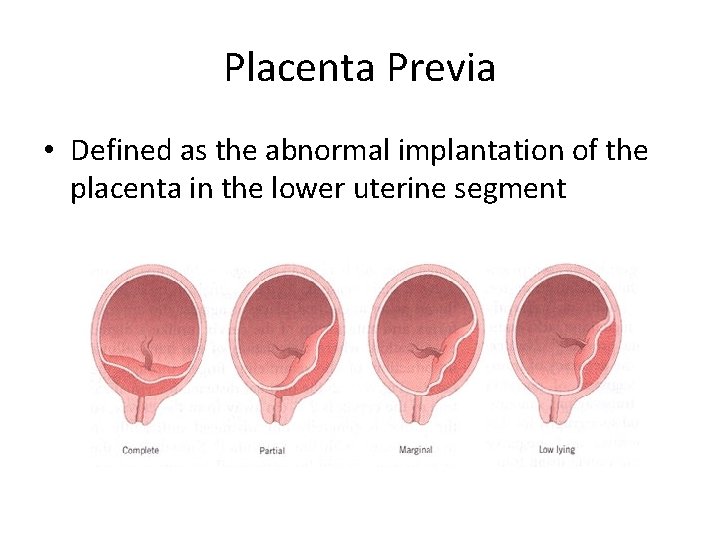 Placenta Previa • Defined as the abnormal implantation of the placenta in the lower