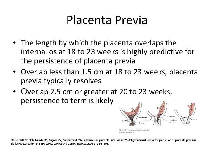 Placenta Previa • The length by which the placenta overlaps the internal os at