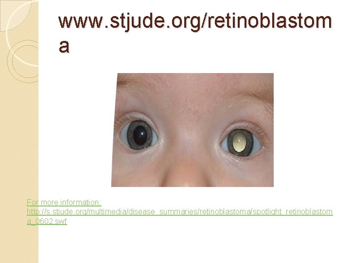 www. stjude. org/retinoblastom a For more information: http: //s. stjude. org/multimedia/disease_summaries/retinoblastoma/spotlight_retinoblastom a_0602. swf 