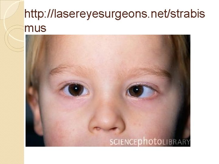 http: //lasereyesurgeons. net/strabis mus 