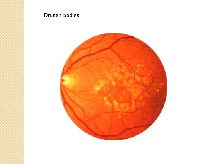 Drusen bodies 