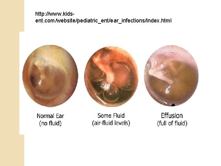 http: //www. kidsent. com/website/pediatric_ent/ear_infections/index. html 