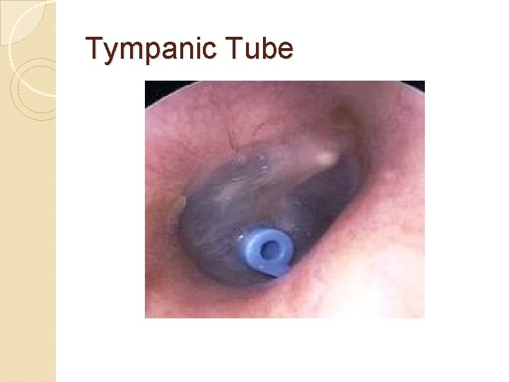 Tympanic Tube 