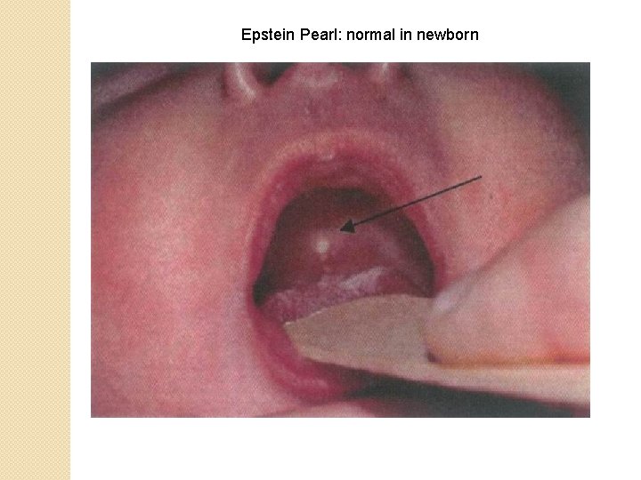 Epstein Pearl: normal in newborn 