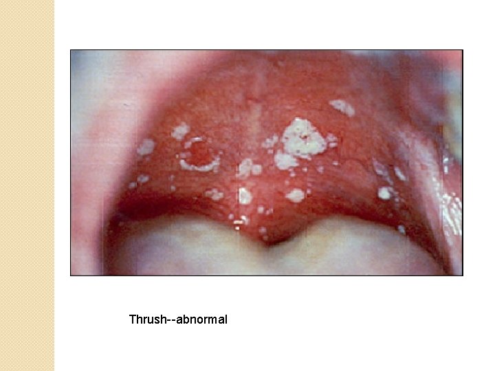 Thrush--abnormal 