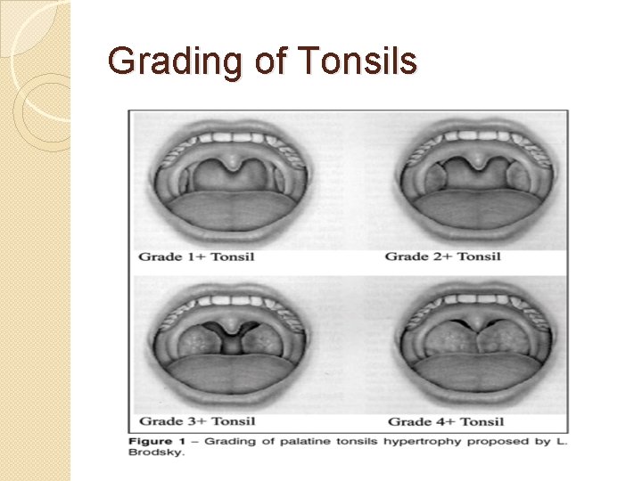 Grading of Tonsils 