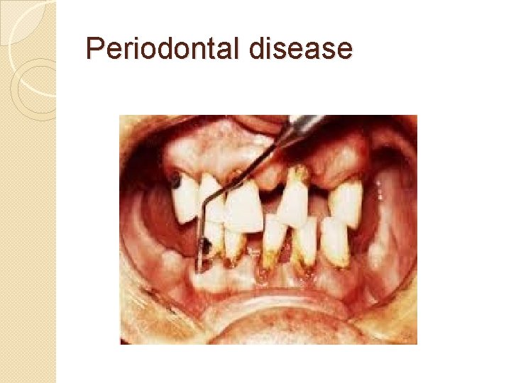 Periodontal disease 