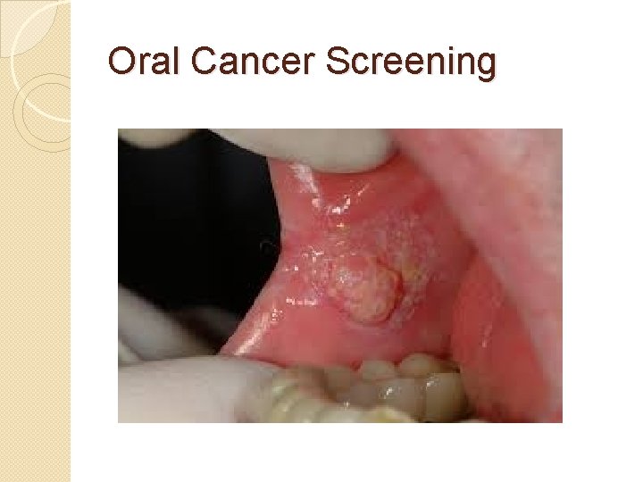 Oral Cancer Screening 