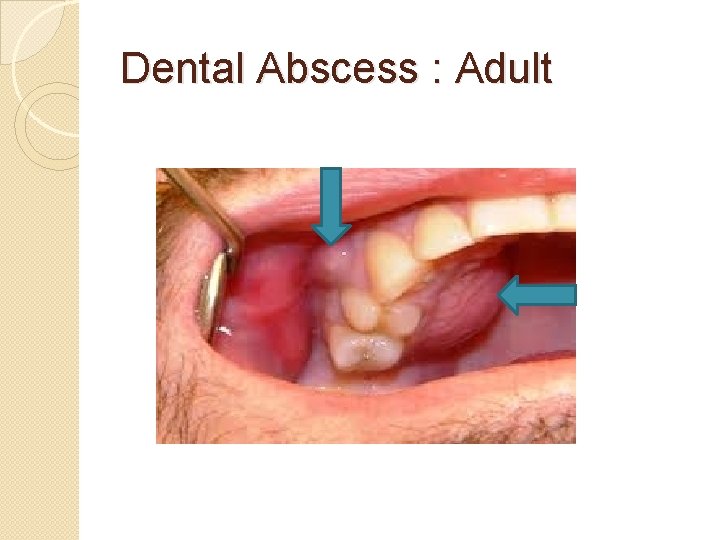 Dental Abscess : Adult 
