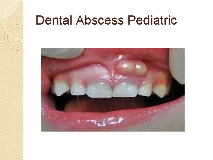Dental Abscess Pediatric 
