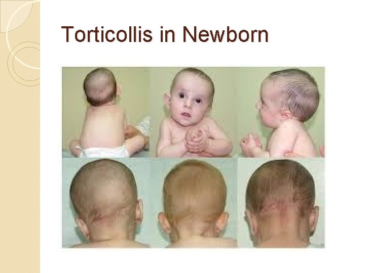 Torticollis in Newborn 