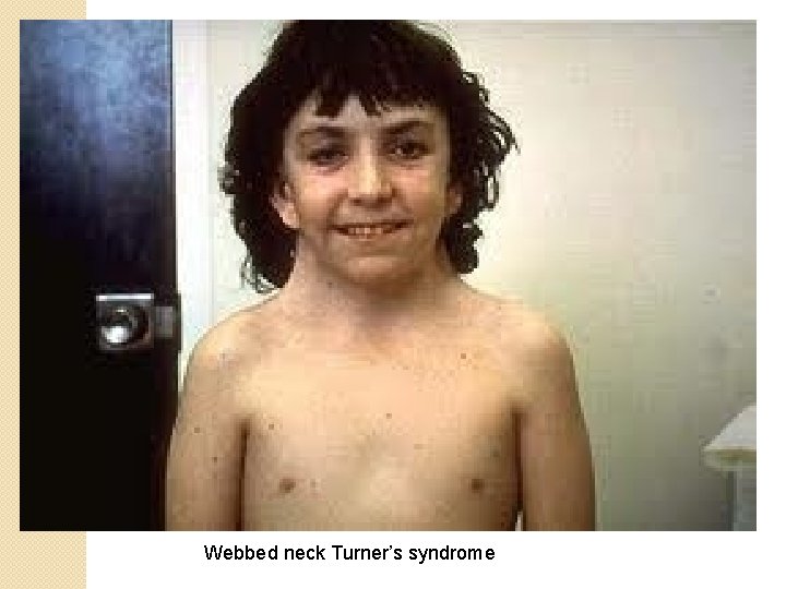 Webbed neck Turner’s syndrome 