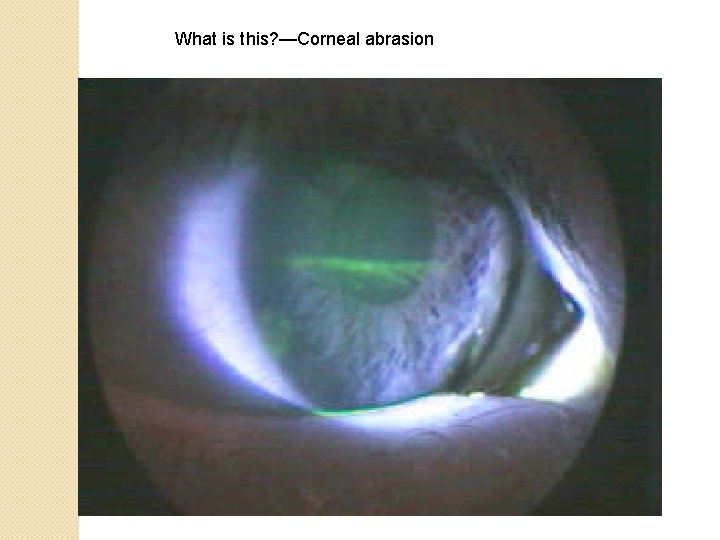 What is this? —Corneal abrasion 