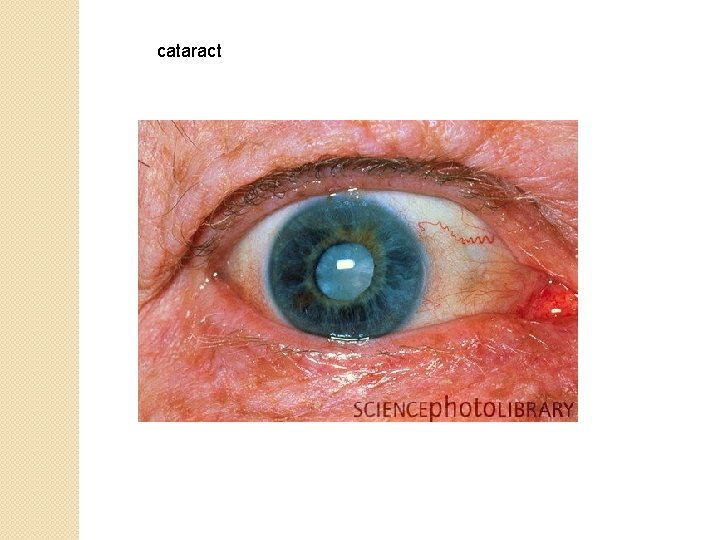 cataract 