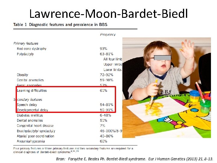 Lawrence-Moon-Bardet-Biedl Bron: Forsythe E, Beales Ph. Bardet-Biedl syndrome. Eur J Human Genetics (2013) 21,