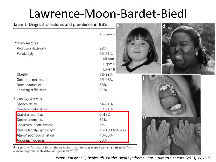 Lawrence-Moon-Bardet-Biedl Bron: Forsythe E, Beales Ph. Bardet-Biedl syndrome. Eur J Human Genetics (2013) 21,