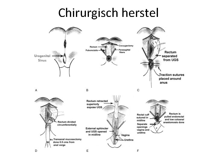 Chirurgisch herstel 